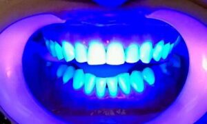 Clareamento Dental: Luz Azul aumenta eficiência com gel Whiteness Perfect